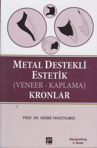 Metal Destekli Estetik (Veneer - Kaplama) Kronlar %5 indirimli Hüsnü Y